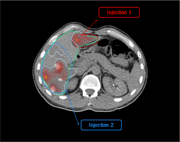 Hermia SIRT showing two injection plans for personalized dosimetry for treating tumors in a liver.