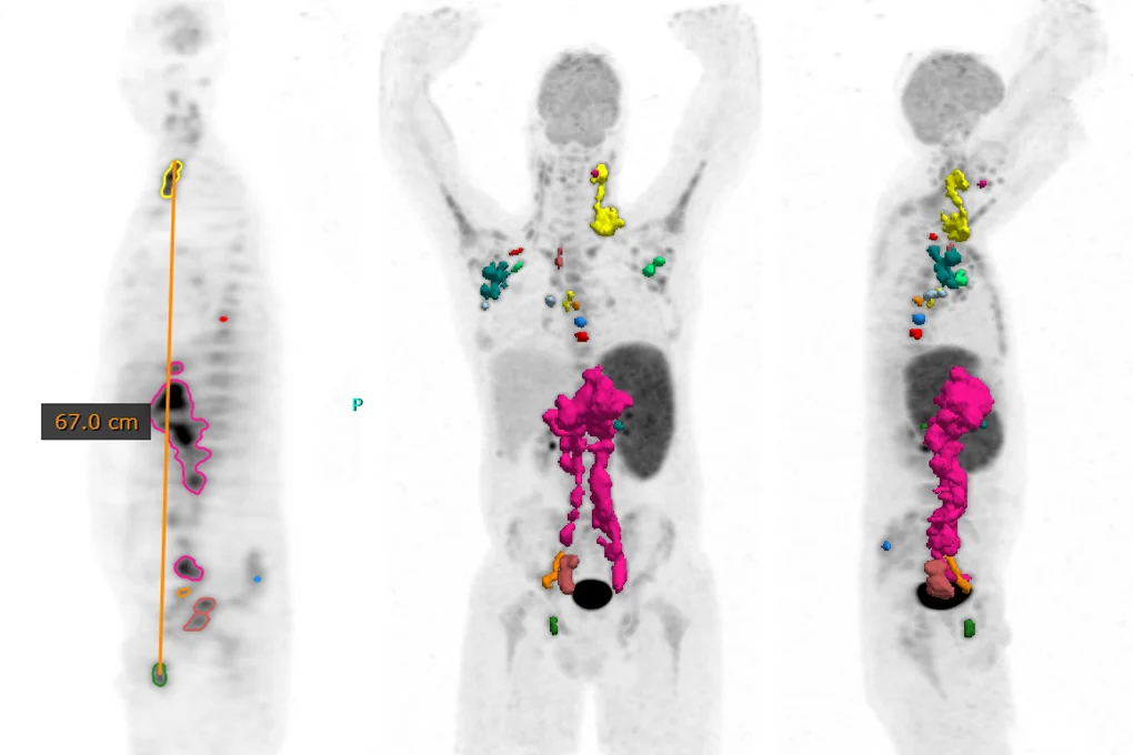 Dmax tool in Hermia Multimodality