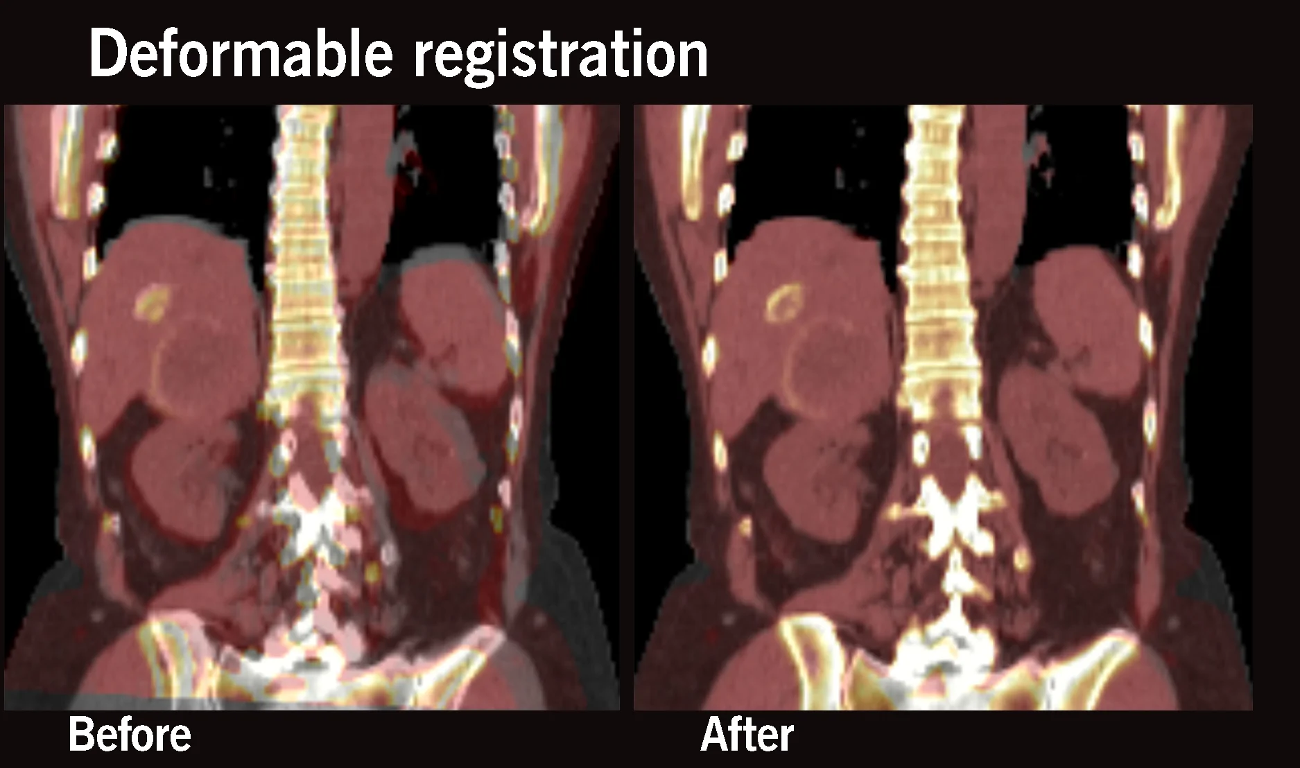 Deformable registration in Hermia Voxel Dosimetry