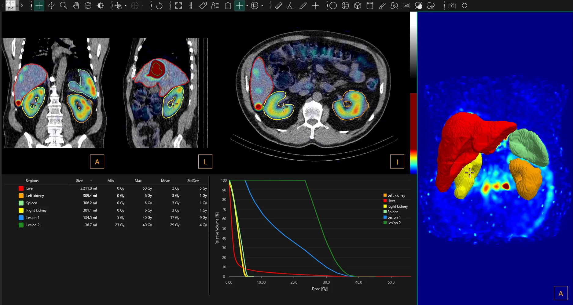 Dosemap of Hermia Voxel Dosimetry
