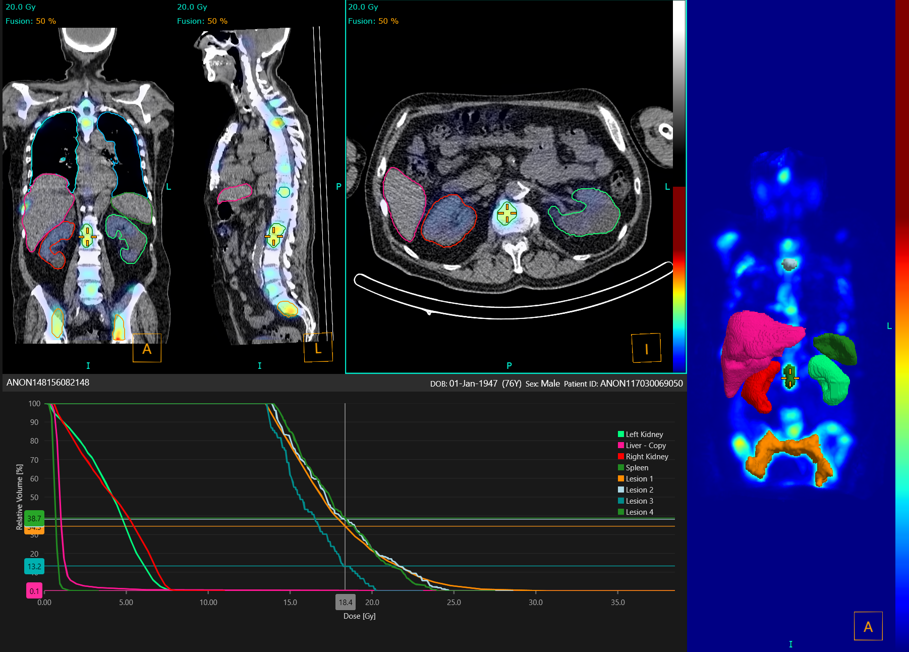 Hermia Multimodality showcasing automatic organ segmentation